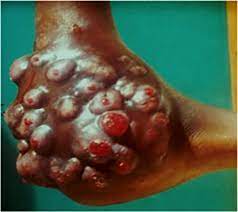 Madura foot — an infection of the tissues and bones of the foot producing chronic inflammation it is caused by various filamentous fungi (including madurella) and certain bacteria of the genera. Mycetoma Epidemiology Diagnosis Management And Outcome In Three Hospital Centres In Senegal From 2008 To 2018
