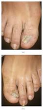 Image result for Onychogryphosis feet