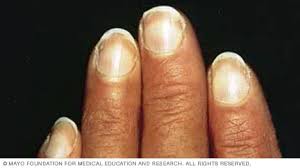 7 مشكلات في أظافر اليد لا ينبغي تجاهُلها - Mayo Clinic (مايو كلينك)
