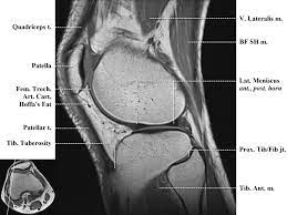 Mri web clinic — may 2015. Http Www Smartview Co Wp Content Uploads 2014 02 Imagen Mr Normal Anatomia Rodilla Pdf