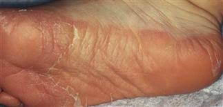 Pityriasis rubra pilaris, also known as prp, is related to familial pityriasis rubra pilaris and pustular psoriasis. Pityriasis Rubra Pilaris Prp Plastic Surgery Key