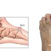 See foot cancer stock video clips. 1