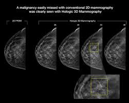 That's only half the story. Finding Value In Digital Breast Tomosynthesis Imaging Technology News