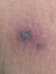 Image result for spinne biss haut reaktion