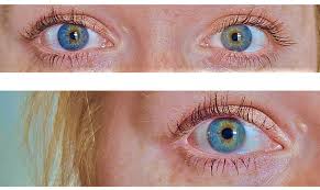 Central heterochromia is when the inner ring of the iris — the eye color closest to your pupil — is a different color than the outer ring, along the edge of your iris. Central Heterochromia Definition Causes And Types Central Heterochromia Heterochromia Beautiful Eyes Color