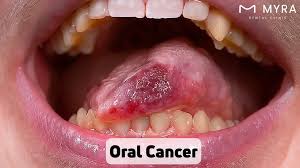 Image result for gum cancer symptoms
