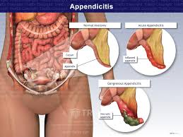 Image result for Appendicitis