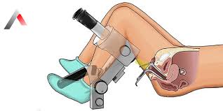 Image result for Colposcopy