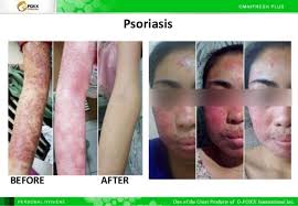 Help Psoriasis with Omni Fresh