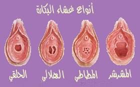 صور غشاء البكارة ترقيع غشاء البكارة صفحه خاصه للمقبلين على الزواج من الجنسين ممنوع دخول أقل من 18 سنه Facebook