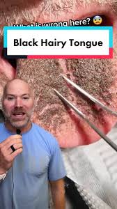 Image result for black hairy tongue symptoms