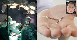 Apa yang dirasakan selepas pembedahan tidak sama antara satu sama lain. Gara Gara Lambat Keluarkan Iucd Selepas Tamat Tempoh 3 Tahun Rahim Wanita Ini Terpaksa Dibedah Pa Ma