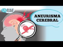 Um aneurisma cerebral, é um ponto fraco em uma artéria cerebral. Aneurisma Cerebral Quando Se Preocupar Youtube