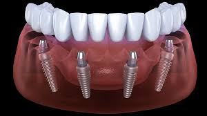 Dentista em Santos explica sobre as vantagens de pontes dentais vs.  implantes dentais