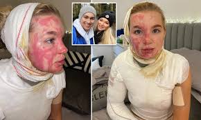 Full body measurements, clothes & shoes size is being updated soon or you can click edit button to update abbie quinnen's height and. Aj Pritchard S Girlfriend Abbie Quinnen Reveals The Horrific Burns She Sustained In Fire Accident Daily Mail Online