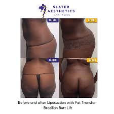 Our mia aesthetics' surgeons have an outstanding track . 1 Brazilian Butt Lift Results By Dr Monte Slater 2 Locations In Ga