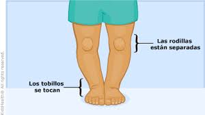 Piernas Arqueadas Genu Varum Para Padres Nemours Kidshealth