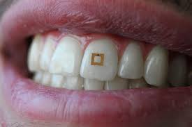 Dental implant an implant is a great way to replace a missing tooth. Scientists Develop Tiny Tooth Mounted Sensors That Can Track What You Eat Tufts Now