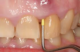 Image result for Periodontal Abscess