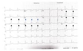 Electrocardiogram (ecg or ekg) to look for changes in your heart rhythm. Pericarditis Ecg Annotated Jetem 2018 Jetem