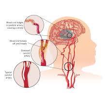 Image result for carotid artery