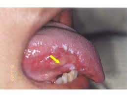 Image result for lichen planus on tongue)