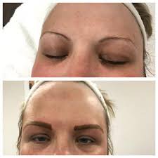 Burns, permanent changes to your skin color, and scars can occur. Vaughan Laser Hair Removal Home Facebook