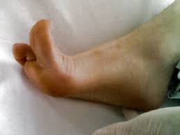 Image result for Babinski Reflex