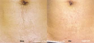 Sidhu is ready to help your true beauty shine. Laser Hair Removal Bellevue Seattle Dermatologist Deetta Gray Md