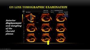 Fetal Abnormalities In 4d Scan Fetal Abnormalities Fetal 4d Ultrasound