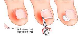 We did not find results for: Ingrown Toenails Specialist In Nyc Overgrown Toe Skin Removal