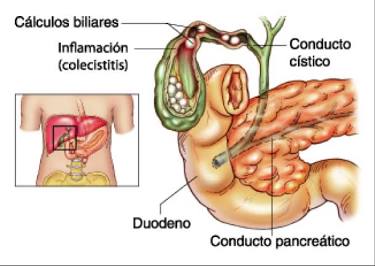 Anatomía De La Litiasis Y Barro Biliar: Vías De Drenaje Y Riesgo De Obstrucción, Generada Por Ia