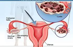 Image result for Cyst