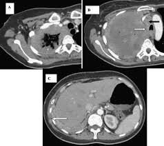 Mesothelioma is a rare type of cancer that that develops in the pleura, a thin membrane that separates the lung from the chest wall. References In Morphologic And Functional Imaging Of Malignant Pleural Mesothelioma European Journal Of Radiology