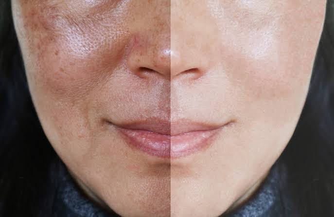 example of uneven skin tone