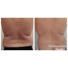 Two Sessions Of Lipo Sculpt Thermalift And Ultrasonic Cavitation Ultrasonic Cavitation Lipo Sculpting