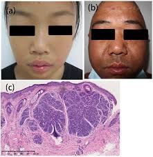 A novel frameshift CYLD mutation in a family with multiple familial  trichoepithelioma