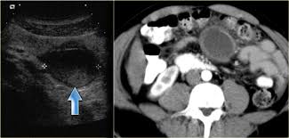 He is an assistant professor of radiology at harvard medical school, in boston, massachusetts, usa. The Radiology Assistant Peritoneal Pathology