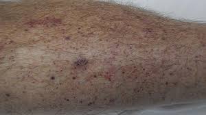 What i thought were signs of a poor diet and a middle age slump were really symptoms of ovarian cancer. Leukemia Rash Pictures Symptoms And When To See A Doctor