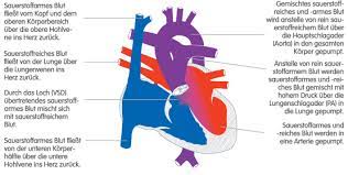 Corience Truncus Arteriosus Communis Oder Gemeinsamer Truncus Arteriosus