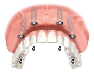 All-on-4 Dental Implant System, AI generated