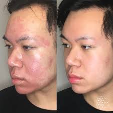 Acne Scar Treatment & Removal Vancouver BC