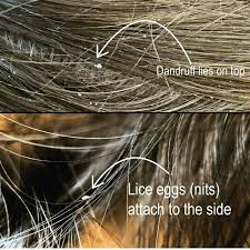 Image result for lice vs dandruff