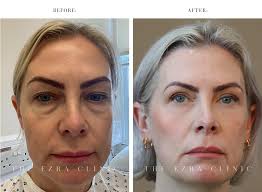 Blepharoplasty London