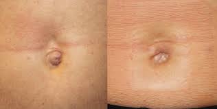 A young belly button is narrow and vertically oblong. Belly Button Surgery Is A Trend And It S On The Rise Shafer David Shaferplasticsurgery Com