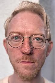 Rhinophyma (Strawberry Nose) Gelatine Prosthetic Used gelatine as the main  material