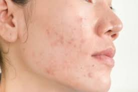 Fraxel laser treatments may also help with acne scarring for people with mild or moderate acne scarring. How Effective Is Fraxel Laser For Acne Scars