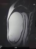 Image result for above what size does a soft tissue mass require tissue diagnosis before definitive treatment