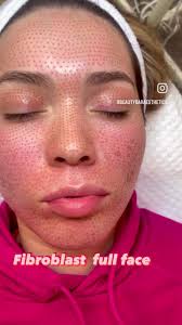 It is performed with a Plasma pen...