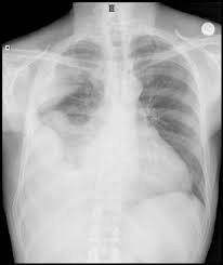 Image result for Parapneumonic Effusion